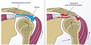 Impingement of van de - Dr.